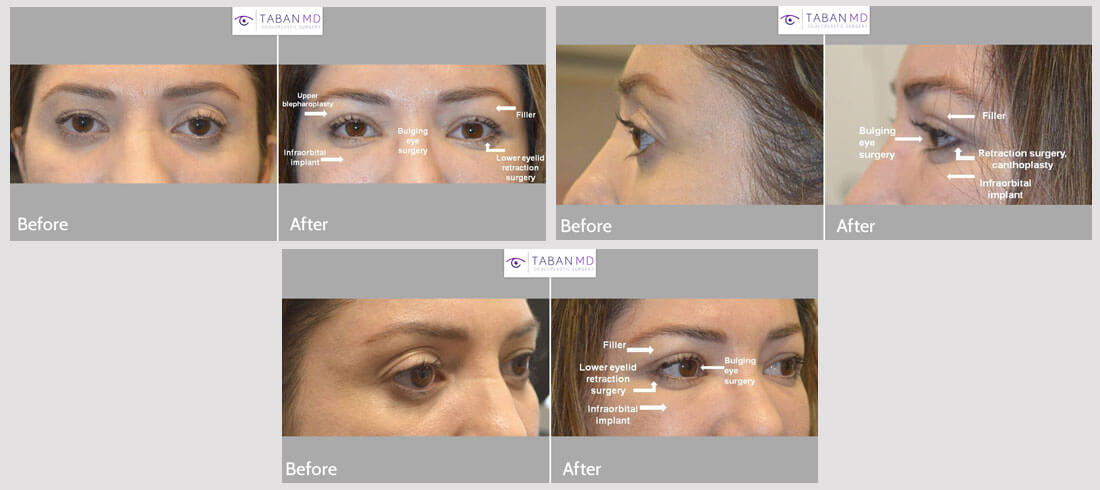 Woman who was unhappy about her eye shape and eye asymmetry, underwent eye plastic surgery including cosmetic bulging eye orbital decompression, infraorbital rim silicone implant, lower eyelid retraction surgery with canthoplasty, right upper blepharoplasty and left upper eyelid filler injection. Note more almond shaped and symmetric eye appearance in the after photo taken 1 month after almond eye surgery.