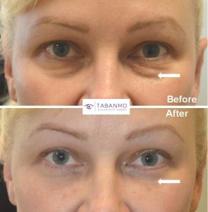 44 year old female, looking tired due to under-eye fat bags and dark circles, underwent transconjunctival lower blepharoplasty with eye fat bags repositioning plus skin pinch. Before and 6 weeks postop photos are shown.