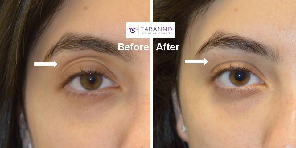 Young woman complained of sunken hollow upper eyelids with loose skin. She underwent upper eyelid filler injection. Before and immediate after treatment photos are shown.