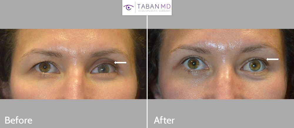 Young woman, with prosthetic (fake) left eye with eye asymmetry, underwent asymmetric upper blepharoplasty and left upper eyelid filler injection along with new prosthesis.