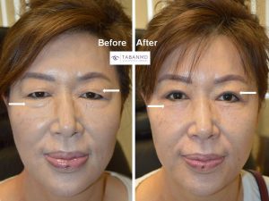 65 year old Asian female, underwent Asian upper blepharoplasty (double eyelid surgery) and lower blepharoplasty, resulting in more youthful, rested, natural eye appearance.