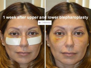 Photo showing healing 1 week after upper blepharoplasty and lower blepharoplasty in a beautiful woman.