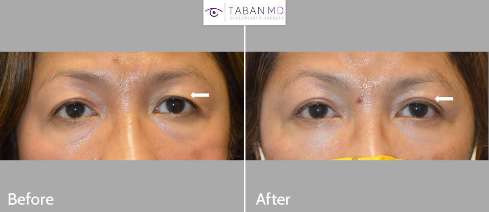 Middle age Asian woman underwent Asian upper blepharoplasty (double eyelid surgery) with natural results.