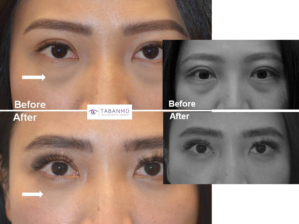 Beautiful young Asian woman, appearing tired due to under eye bags and dark circles, underwent scarless transconjunctival lower blepharoplasty with eye fat repositioning. Note more youthful eye appearance.