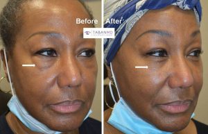 66 year old female, underwent scarless lower blepharoplasty (transconjunctival technique with fat repositioning) to improve under eye fat bags. Note more rested, youthful, natural eye appearance after cosmetic eyelid surgery.