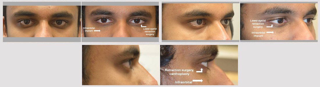 Young man, with sad tired eye appearance, underwent lower eyelid retraction surgery with canthoplasty (almond eye surgery) plus infraorbital rim silicone implant. Note improved eye shape with more almond eyes.