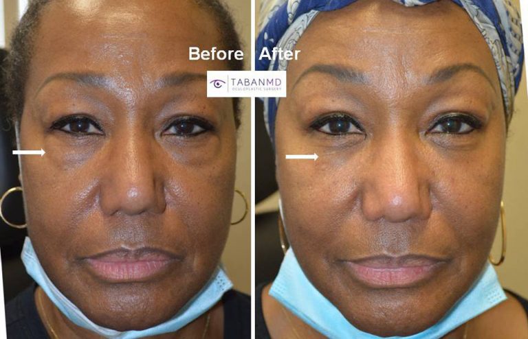 Lower Blepharoplasty Beverly Hills Under Eye Bag Dark Circle 