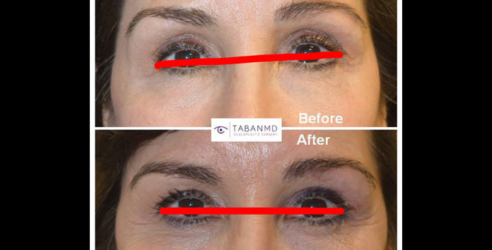 eye-asymmetry-surgery-and-treatment-fix-uneven-eyes