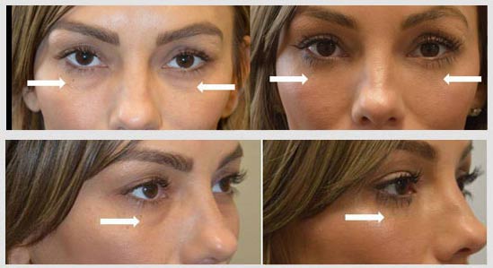 Our own office surgical coordinator (Tasha) underwent, complained of looking tired due to under eye fat bags and dark circles, needing to apply a lot of cover up makeup. She underwent transconjunctival lower blepharoplasty with fat repositioning and skin pinch. Before and 2 months after eyelid surgery photos are shown.