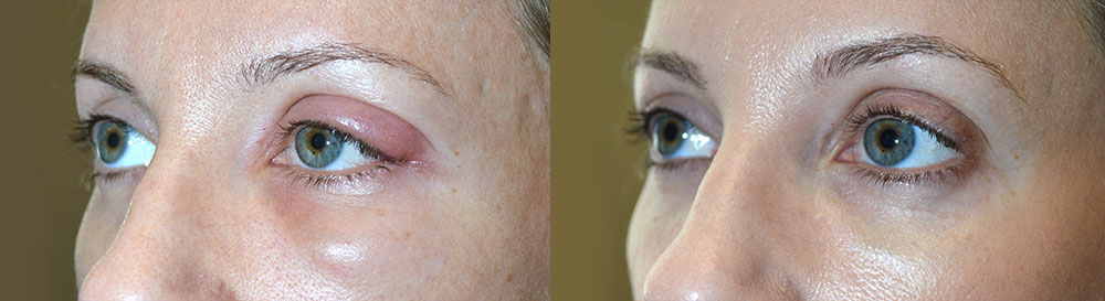 Before (left) 37 year old female, with large left eyelid stye (chalazion). After (right) 1+ month after left upper eyelid stye (chalazion) drainage.
