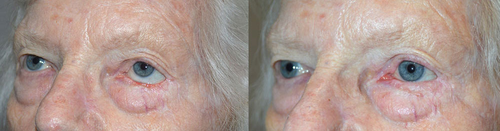 Before (left) 70+ year old female, with left lower eyelid retraction from previous skin cancer surgery. After (right) 3 months after total left lower eyelid reconstruction, retraction surgery, with skin graft.