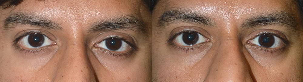 Before (left) Young male, with eye size asymmetry, secondary to right upper eyelid retraction. After (right) 3 months after right upper eyelid retraction correction. Note improved eye symmetry.