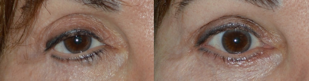 Before (left) Middle age woman with multiple prior eyelid surgeries and blepharoplasty, resulting in right lateral canthal angle distortion and lowering, unnatural right lower eyelid contour, and droopy upper eyelid. After (right) 2 months after revisional eyelid surgery, right canthoplasty, right lower eyelid retraction surgery (internal, with midface lift, without graft) and lower eyelid contour surgery. Fat injection in upper eyelids.
