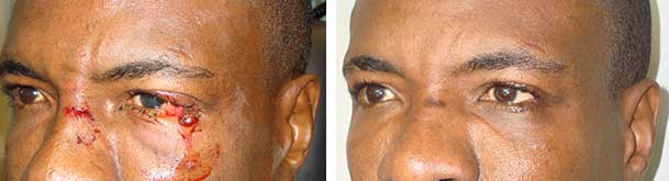 Before (left) and after (right) of an eyelid laceration.