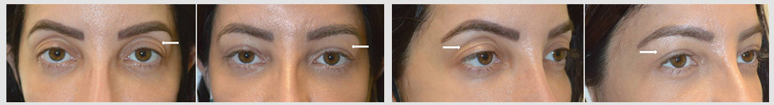 Young beautiful woman, with loose upper eyelid skin and upper eyelid hollowness, underwent upper blepharoplasty plus upper eyelid filler injection plus canthoplasty. Note resultant more youthful eye appearance.