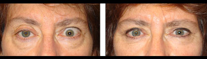 Before (left) and 3 months after (right photo) of right upper eyelid ptosis surgery, left upper eyelid retraction procedure and bilateral lower blepharoplasty.