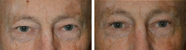 Before (left) and 2 months after (right photo) mid-forehead brow lift and upper blepharoplasty.