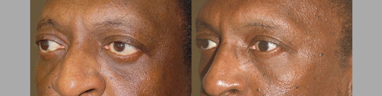 Middle age male, with thyroid eye disease, who underwent orbital decompression followed later by lower eyelid retraction surgery and canthoplasty to give more almond shape eyes.