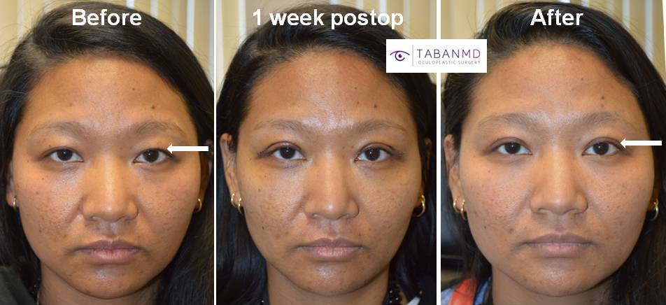 Eye crease surgery hot sale before and after