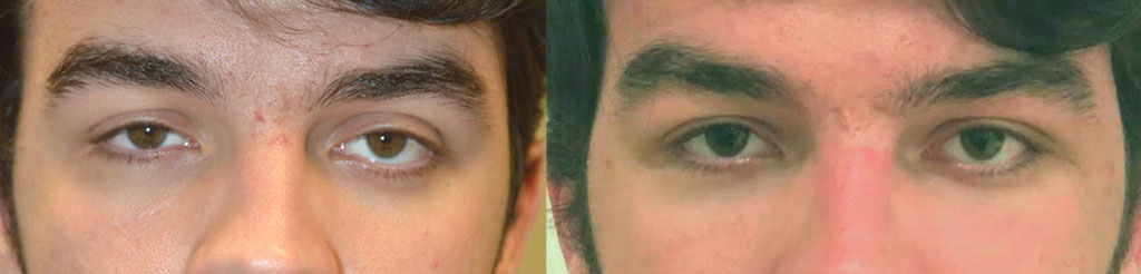 20 year old male, complained of uneven asymmetric eyes. This is due to the sunken right eye from an orbital blow out fracture and congenital left lower eyelid retraction. He already had right orbital fracture repair by another surgeon with persistent enophthalmos (sunken eye). He underwent left orbital decompression plus left lower eyelid retraction surgery. He also underwent droopy upper eyelid ptosis surgery on both eyes. Before and 6 weeks after eye plastic surgery photos are shown. Note improved eye symmetry and youthful eyes.