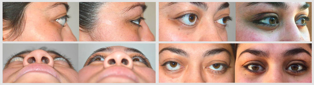 Before (left), 24 year old female, with severe bulgy eyes and lower eyelid retraction from Grave's Disease, with significant change in eye appearance and function. After (right), 1 month after bilateral orbital decompression surgery and lower eyelid retraction surgery. Note improved eye appearance.