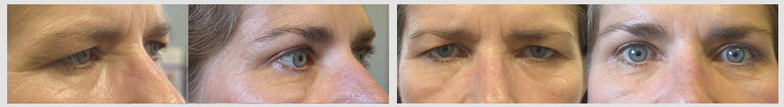 Before (left) and after (right) 55 year old female, with droopy forehead/brows and excess upper eyelid skin, looking tired and angry, underwent endoscopic forehead lift and upper blepharoplasty. Before and 3 months after cosmetic surgery photos are shown.