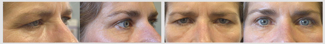 55 year old female, with droopy forehead/brows and excess upper eyelid skin, looking tired and angry, underwent endoscopic forehead lift and upper blepharoplasty. Before and 3 months after cosmetic surgery photos are shown.