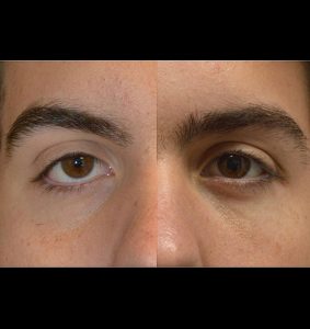 18 year old male, with congenital lower eyelid retraction with negative canthal tilt and droopy upper eyelids (ptosis) underwent almond eye surgery including lower eyelid retraction surgery (with internal alloderm spacer graft), canthoplasty, and upper eyelid ptosis surgery. Before and 3 months after cosmetic eye transforming surgery photos are shown.