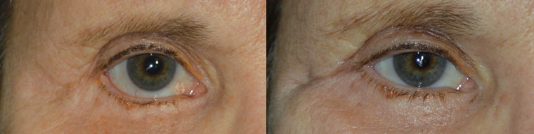 Before (left) Middle age woman with right lower eyelid retraction after previous lower blepharoplasty, now needing revision cosmetic surgery. After (right) 4 months after right lower eyelid retraction surgery with internal Alloderm graft, midface lift, canthoplasty, giving more natural almond shape eye appearance. (later she would also benefit from ptosis surgery and brow lift).