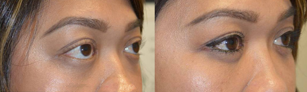 Young Asian female, with inherited bulging eyes, lower eyelid retraction with sclera show, underwent scarless orbital decompression and lower eyelid retraction surgery. She can now close her eyes normally with improved natural eye shape.