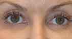 combined-upper-blepharoplasty-3