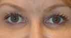 combined-upper-blepharoplasty-3