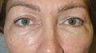Lower Blepharoplasty with Skin Pinch Before