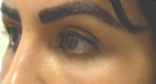 Upper Eyelid/Brow Filler Injections After Image