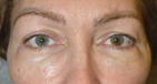 Lower Blepharoplasty in Eyelids Previously Injected with HA Fillers After Image