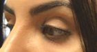 Upper Eyelid/Brow Filler Injections Before iamge