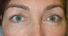 Lower Blepharoplasty in Eyelids Previously Injected with HA Fillers Before image