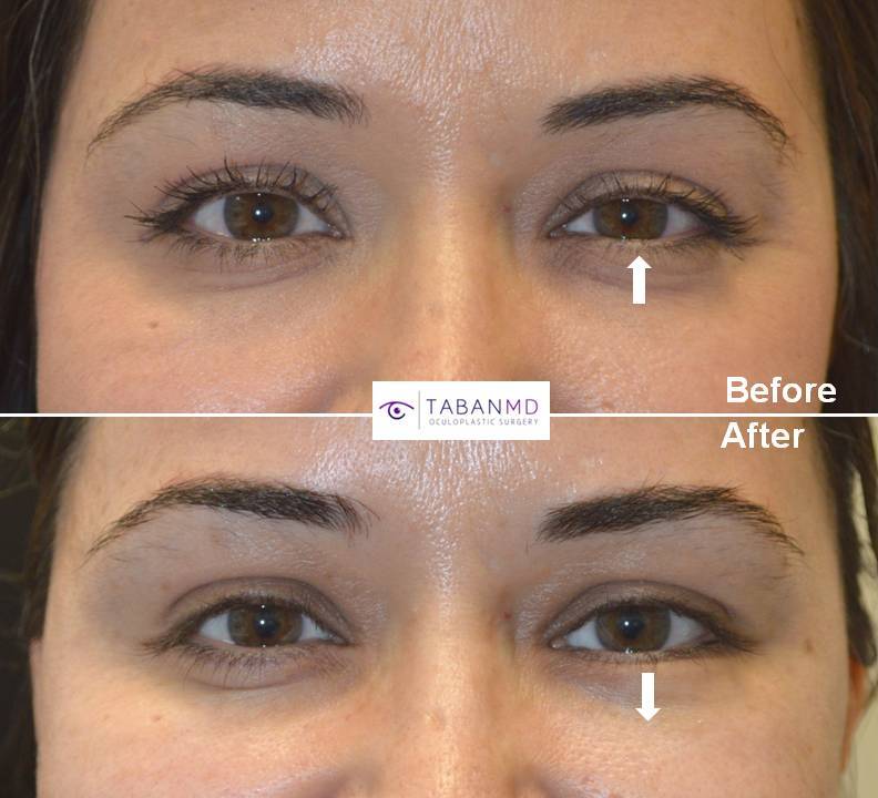 how to fix uneven eyelids