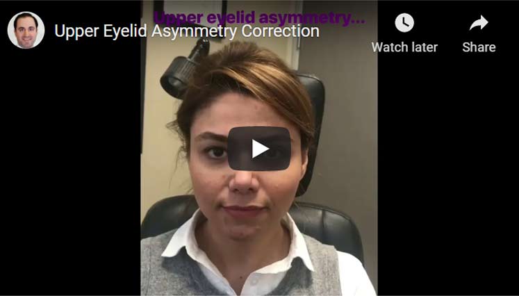 Upper Eyelid Asymmetry Correction