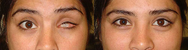 Before (left) and after (right) prosthetic eye (after enucleation/eye removal)