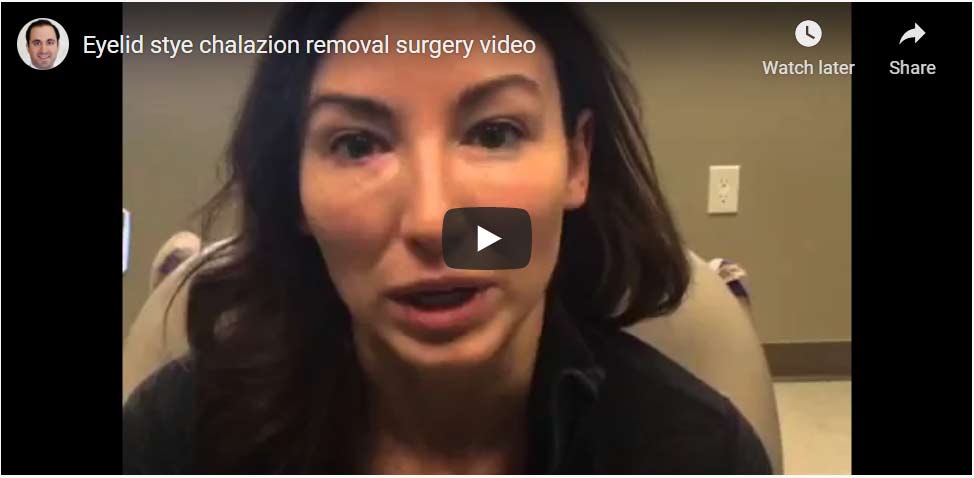 Eyelid stye chalazion removal surgery video