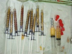 Eyelid and Facial Fat Transfer / Fat Graft / Fat Injection
