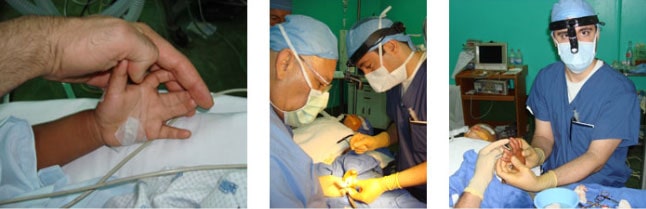 fused finger surgery plastic surgeon