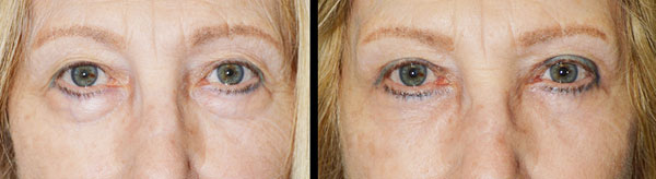 Before (left) and 3 months after (right) cosmetic quad-blepharoplasty, meaning bilateral upper blepharoplasty (with skin removed from upper eyelids) and bilateral lower blepharoplasty (transconjunctival incision with fat redraping).