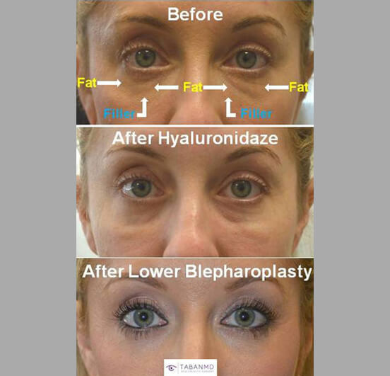 37 year old female, with history of unsuccessful under eye filler (to camouflage under eye fat bags) underwent initial hyaluronidaze to dissolve the filler followed later by transconjunctival lower blepharoplasty with fat bags repositioning and skin pinch. Before and 3 months after eyelid surgery photos are shown.