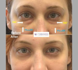 32 year old female, with previous indequate under eye filler injection to tear trough area, underwent first hyaluronidase to remove the filler and then lower blepharoplasty (transconjunctival with fat repositioning with skin pinch). Note youthful natural results with much more improved under eye appearance.