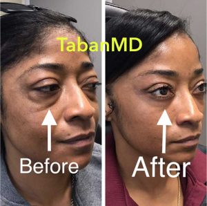 42 year old African American woman, underwent scarless lower blepharoplasty (transconjunctival technique with under eye fat bags repositioning) plus lacrimal gland repositioning. Before and 2 months after eyelid surgery photos are shown. Note more youthful eye appearance with natural results.