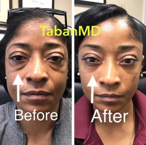 42 year old African American woman, underwent scarless lower blepharoplasty (transconjunctival technique with under eye fat bags repositioning) plus lacrimal gland repositioning. Before and 2 months after eyelid surgery photos are shown. Note more youthful eye appearance with natural results.