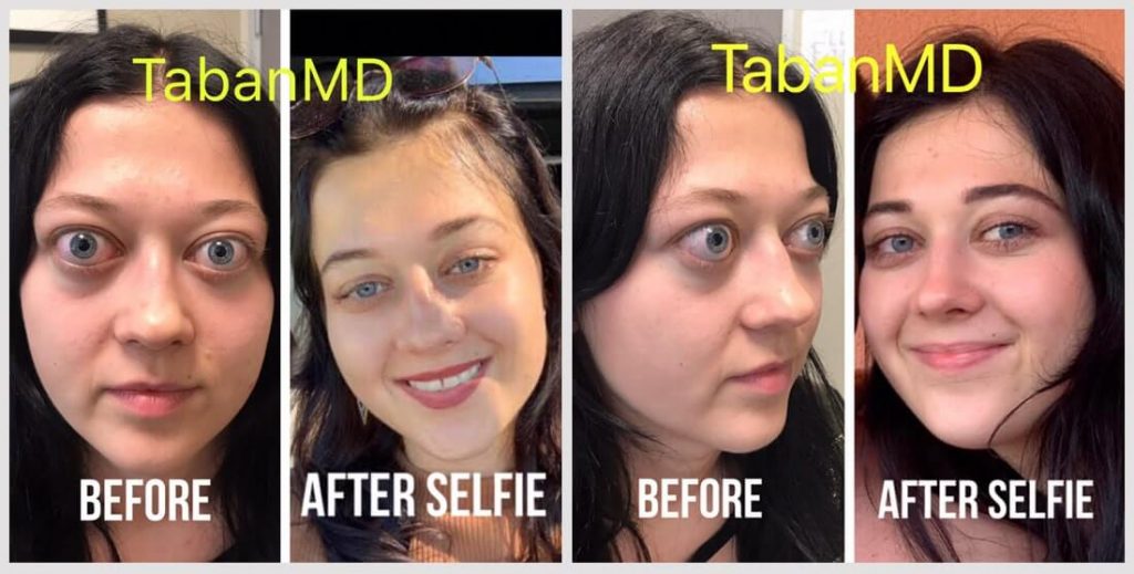 Orbital Surgery Beverly Hills Bulgy Eye Surgery Taban