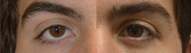 18-year-old male, with congenital lower eyelid retraction with negative canthal tilt and droopy upper eyelids underwent almond eye surgery including lower eyelid retraction surgery (with internal alloderm spacer graft), canthoplasty, and upper eyelid ptosis surgery. Before and 3 months after cosmetic eye transforming surgery photos are shown.